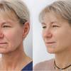 Metoda EasyLift® - dlaczego warto 5